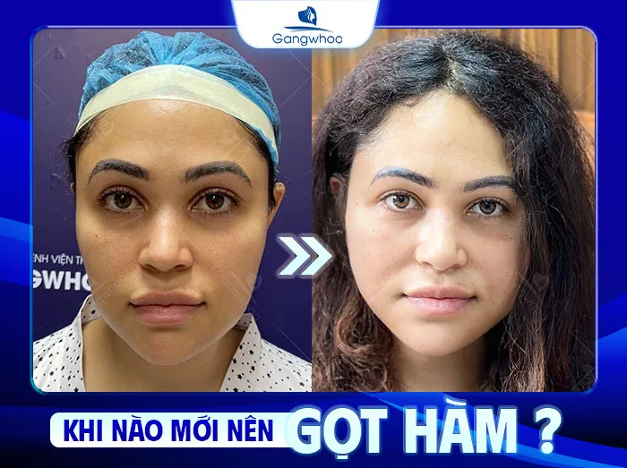 Có Nên Gọt Hàm Không? Khi Nào Mới Nên Gọt Hàm?
