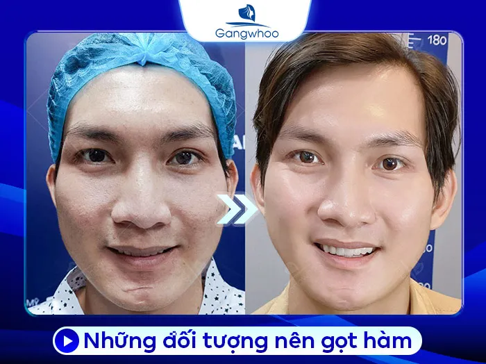 Có Nên Gọt Hàm Không? Khi Nào Mới Nên Gọt Hàm?