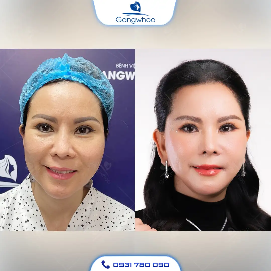 Gọt Hàm Có Vĩnh Viễn Không? Gọt Hàm V-Line Duy Trì Được Bao Lâu?