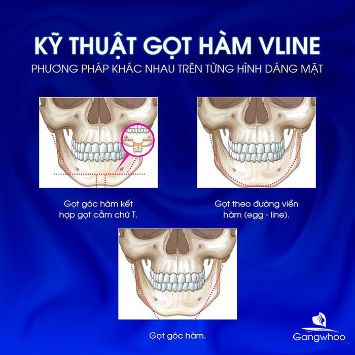 Phẫu thuật gọt hàm có vĩnh viễn không?