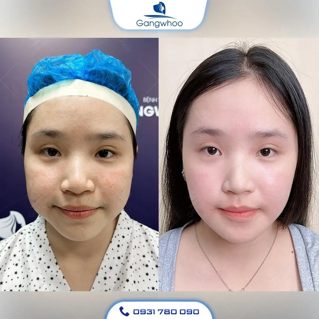 Gọt Hàm Hạ Gò Má Có Nguy Hiểm Không?