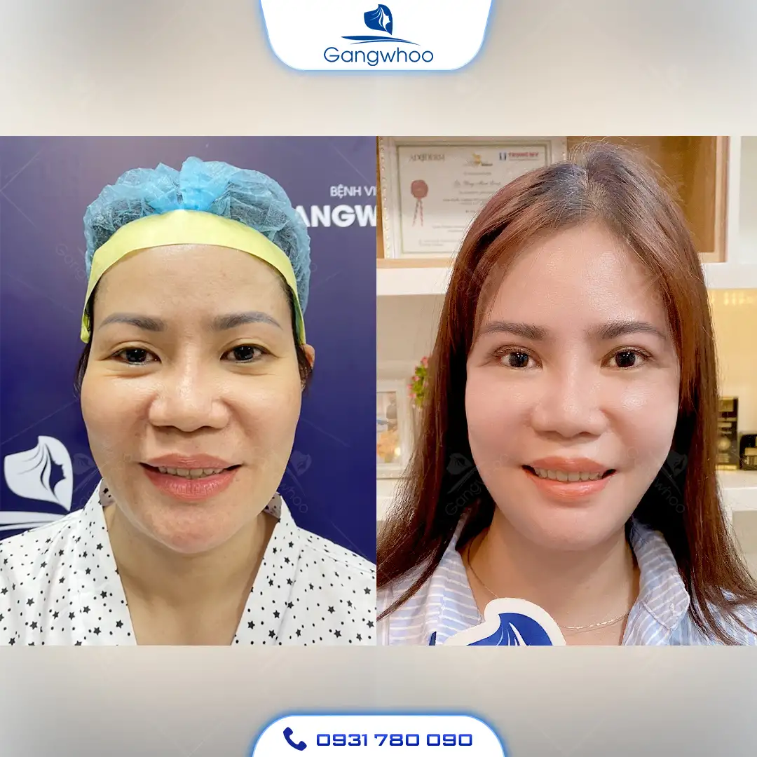 Gọt Hàm Hạ Gò Má Có Nguy Hiểm Không?