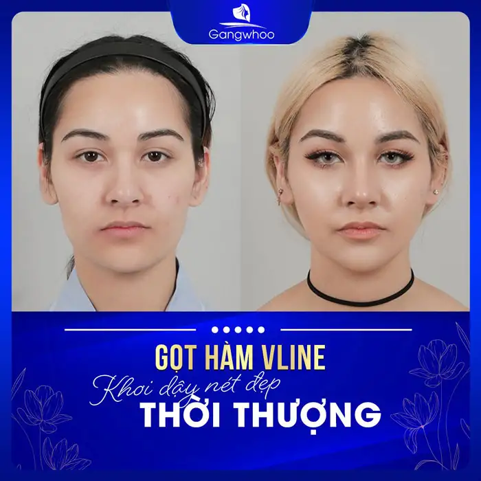 Gọt Hàm Hạ Gò Má Có Nguy Hiểm Không?