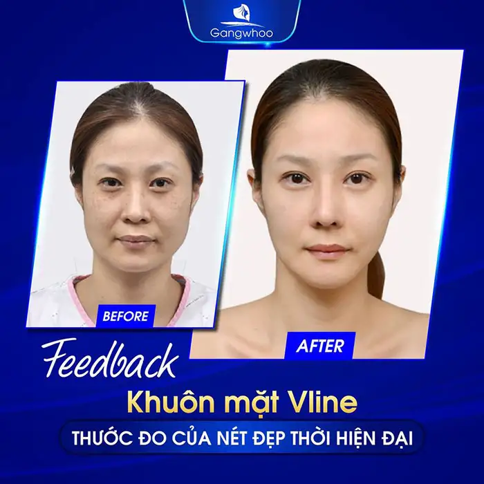 Giải Đáp: Gọt Hàm Sau Bao Lâu Thì Hết Tê?