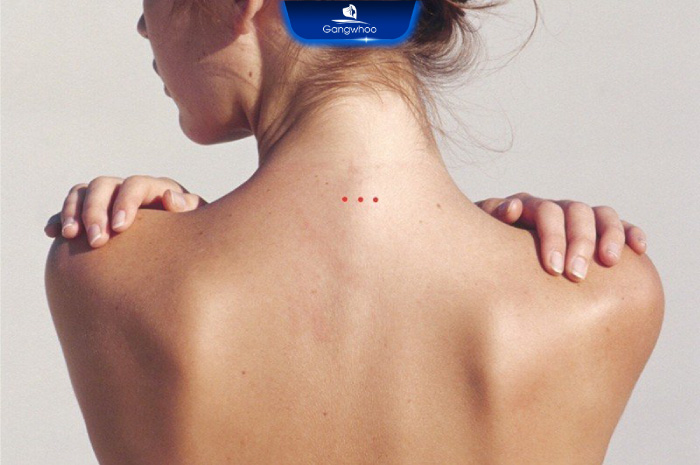 Nốt ruồi sau gáy nam - Ý nghĩa và tẩy nốt ruồi