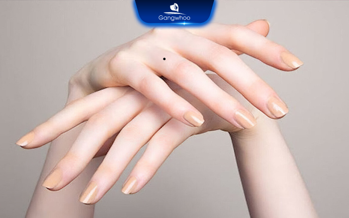 Nốt ruồi ở ngón tay áp út nam nữ nói lên ý nghĩa gì?