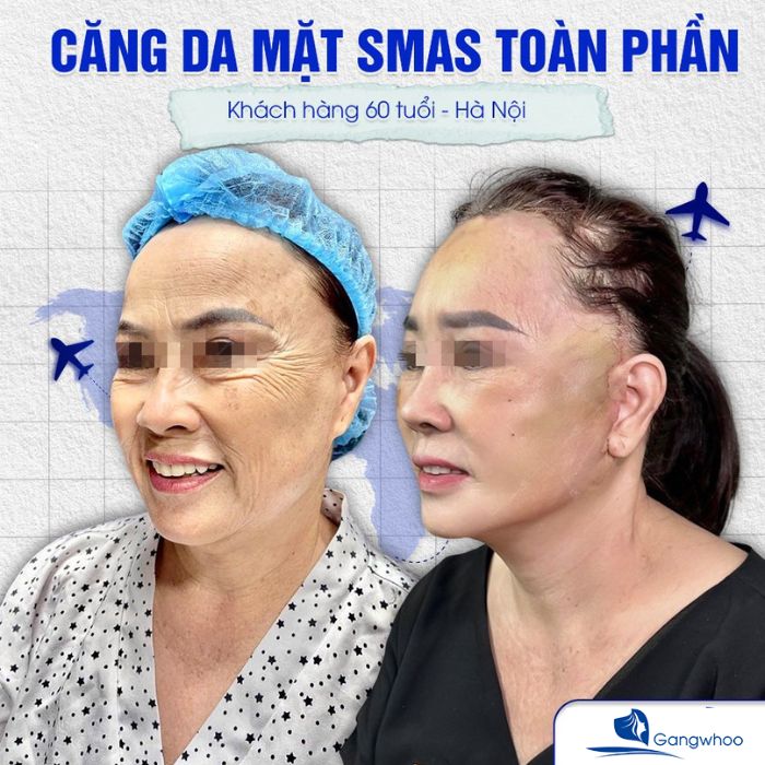 Căng da mặt SMAS - CÔng nghệ căng da được chuyển giao tại TMV Gangwhoo