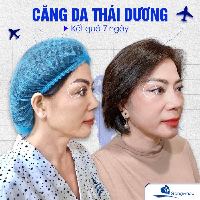 Căng da mặt một vùng nhỏ trên khuôn mặt sẽ rẻ hơn so với căng da mặt toàn phần