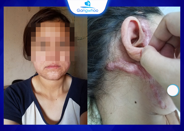 Rủi ro khi căng da mặt tại cơ sở kém uy tín.