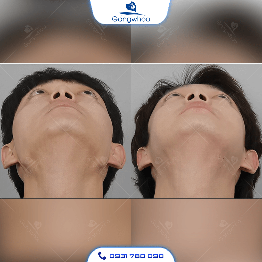 Gọt Hàm Có Đau Không? 4 Yếu Tố Dẫn Đến Gọt Hàm Bị Đau