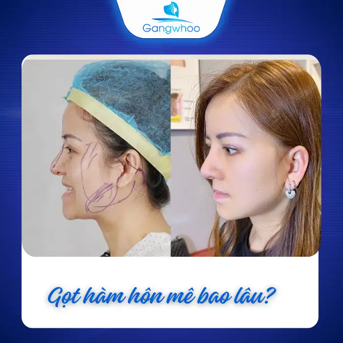 Gọt Hàm Hôn Mê Bao Lâu? Quy Trình Gây Mê Bạn Nên Biết?