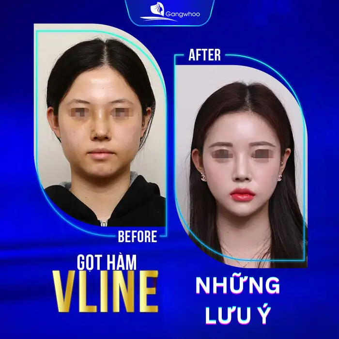 Gọt Hàm Hôn Mê Bao Lâu? Quy Trình Gây Mê Bạn Nên Biết?