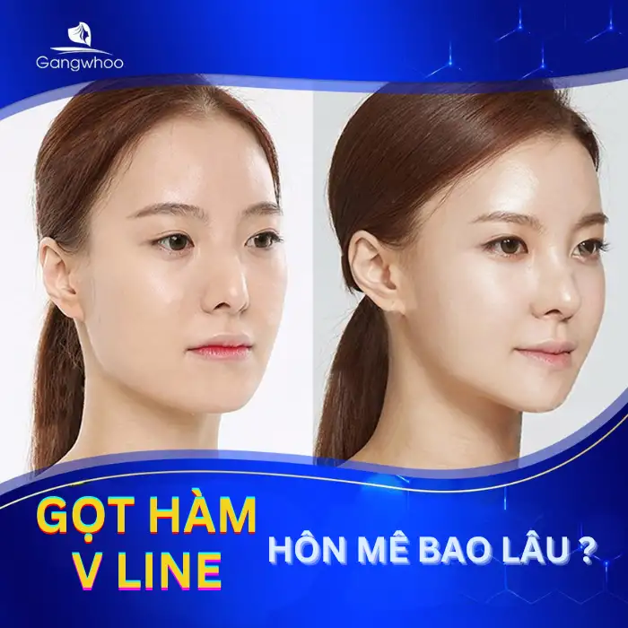 Gọt Hàm Hôn Mê Bao Lâu? Quy Trình Gây Mê Bạn Nên Biết?