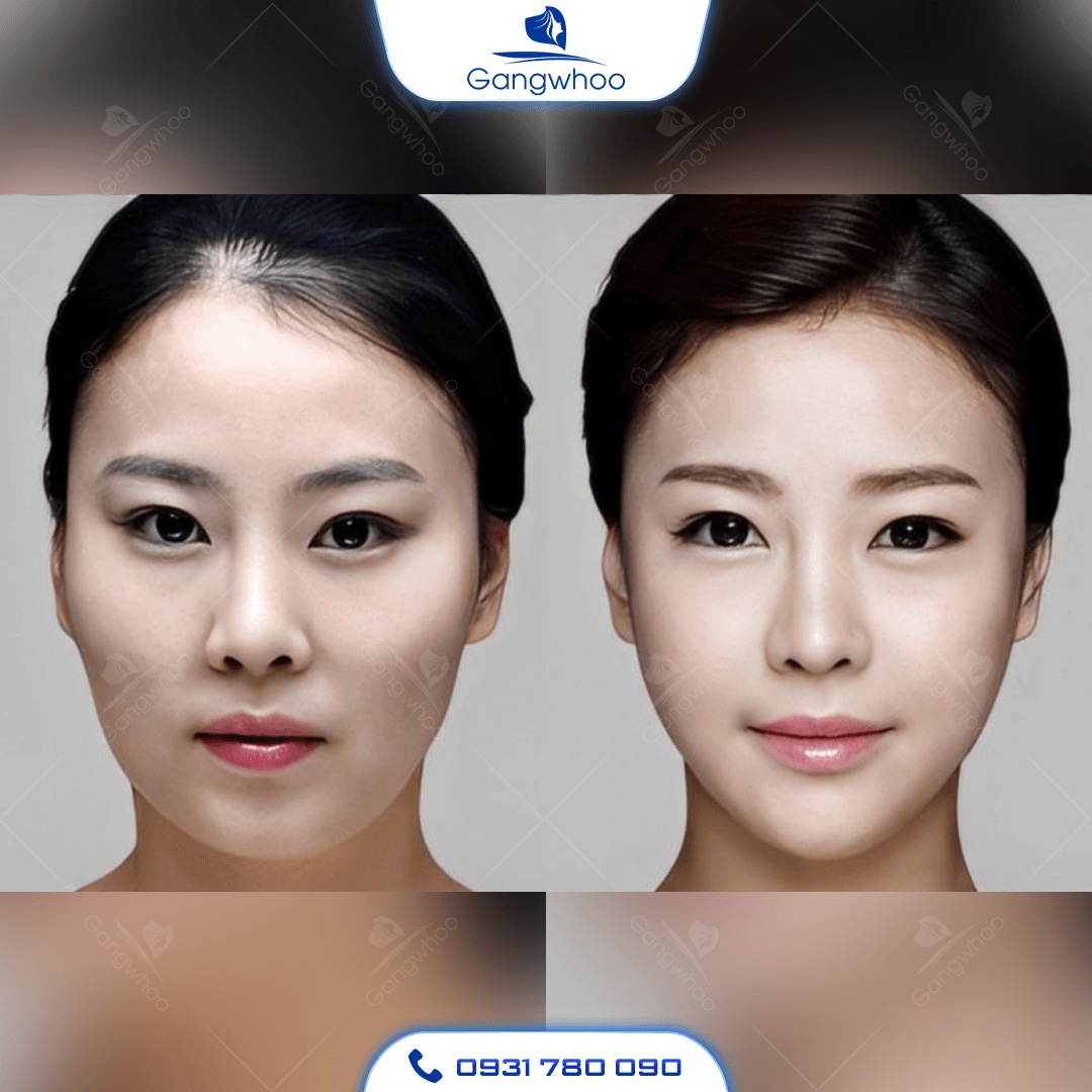 Gọt Hàm Giá Bao Nhiêu? Cập Nhật Bảng Giá Mới Nhất 2024