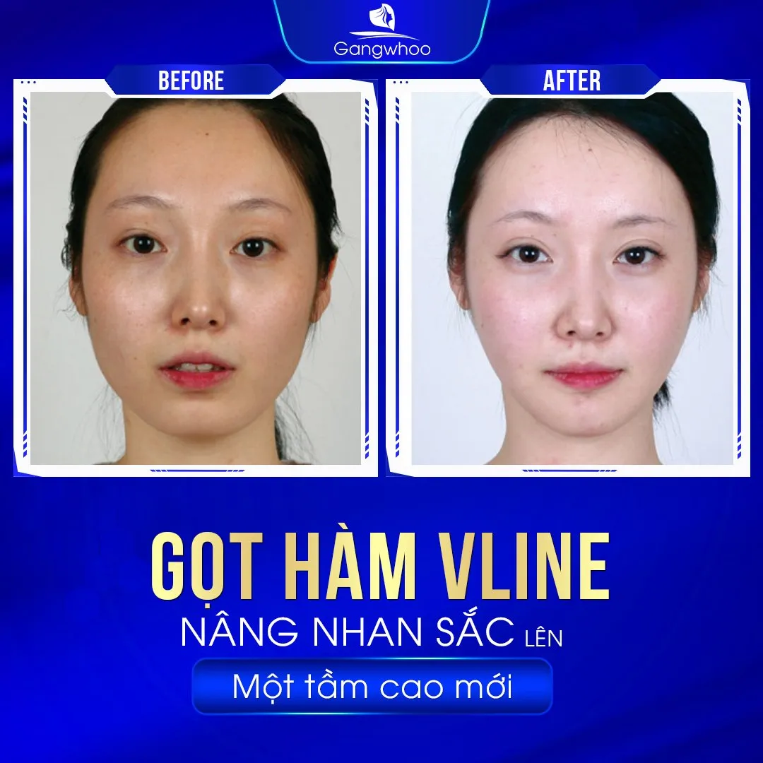Gọt Hàm Giá Bao Nhiêu? Cập Nhật Bảng Giá Mới Nhất 2024
