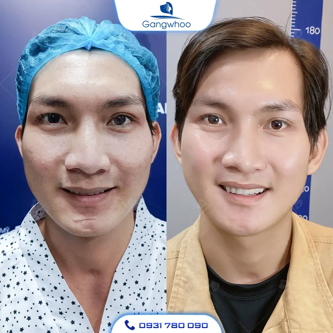 Gọt Hàm Nghỉ Dưỡng Bao Lâu? 4 Yếu Tố Giúp Phục Hồi Nhanh  