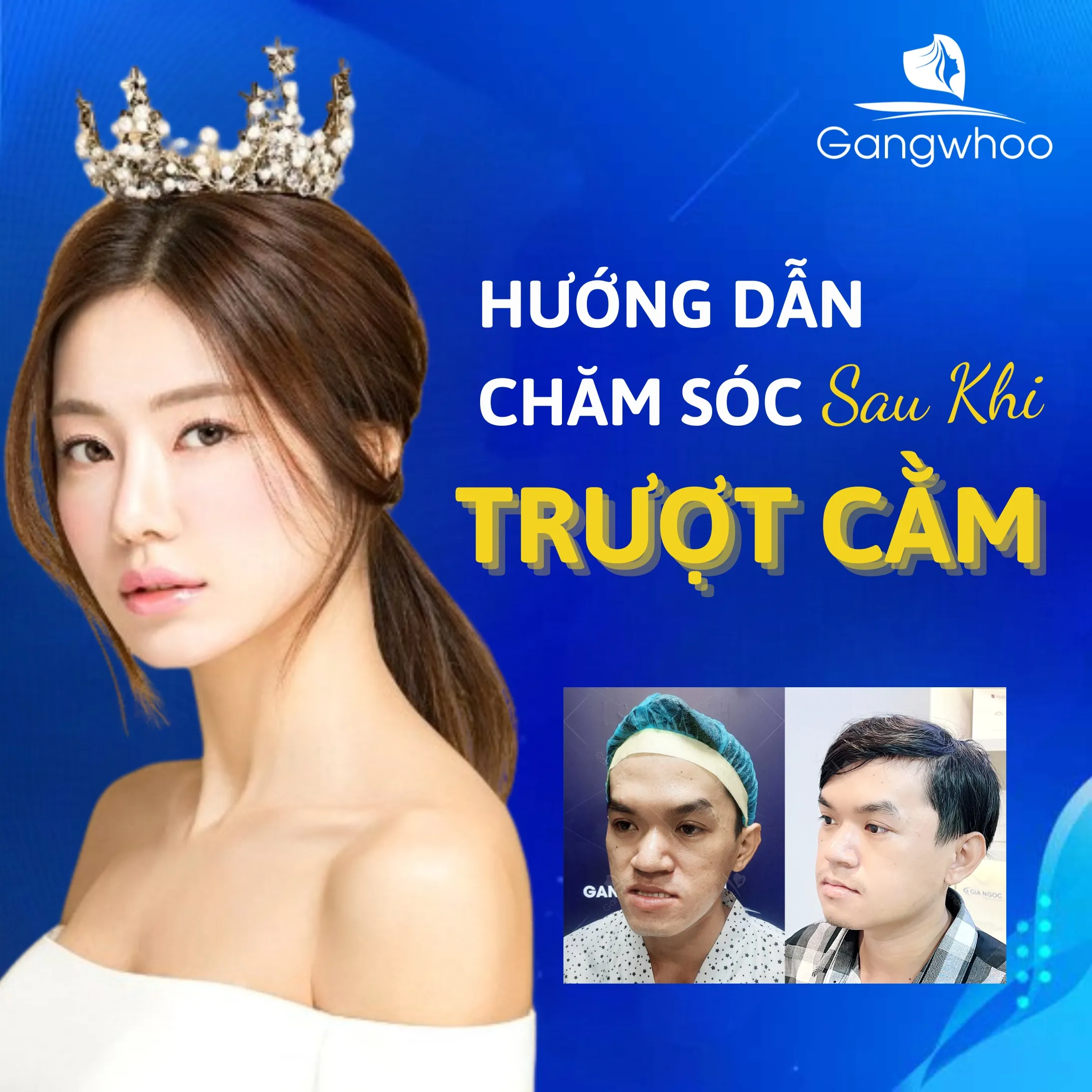 Những Tác Hại Của Trượt Cằm Mang Lại Sau Phẫu Thuật? 