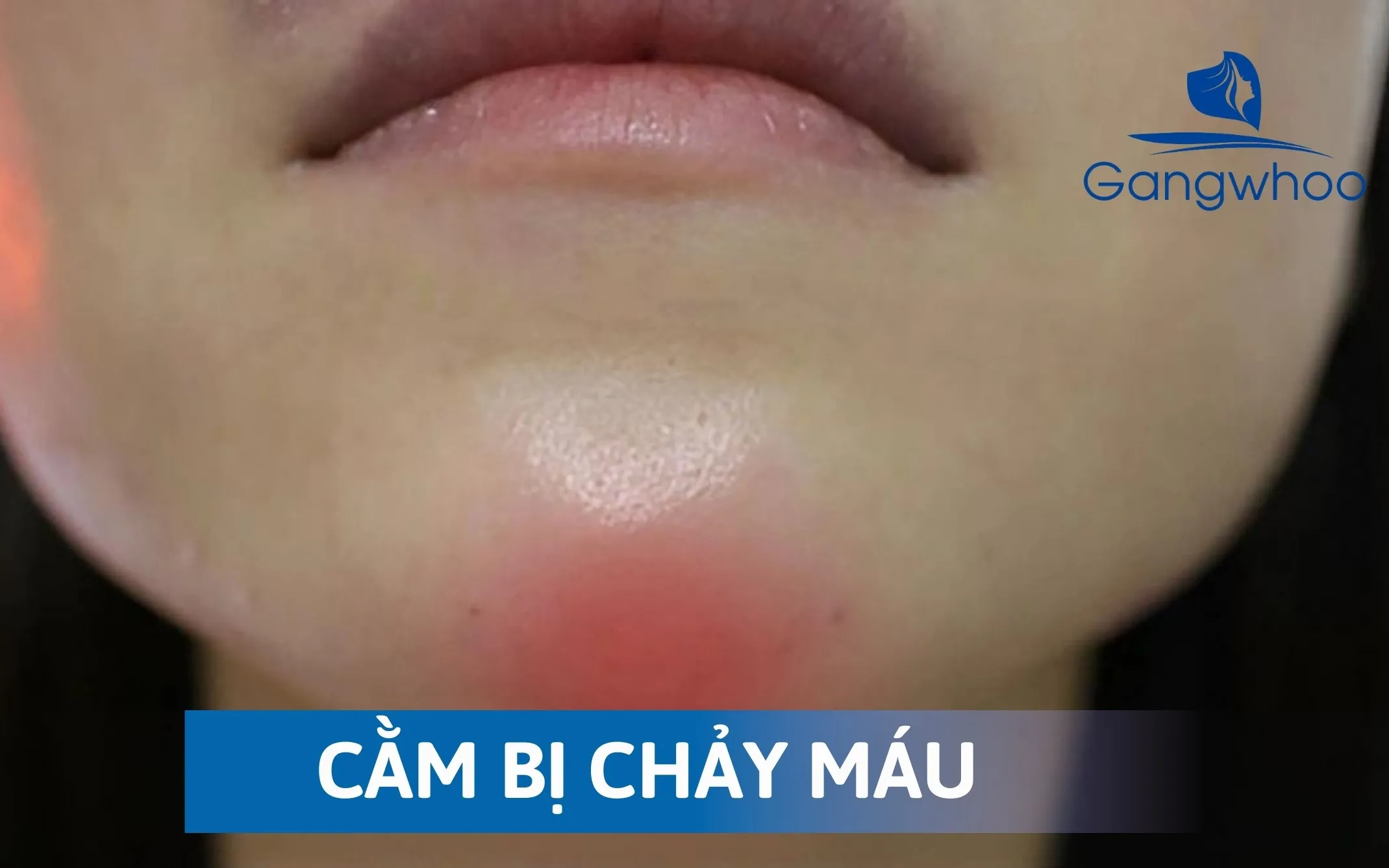 Những Tác Hại Của Trượt Cằm Mang Lại Sau Phẫu Thuật? 