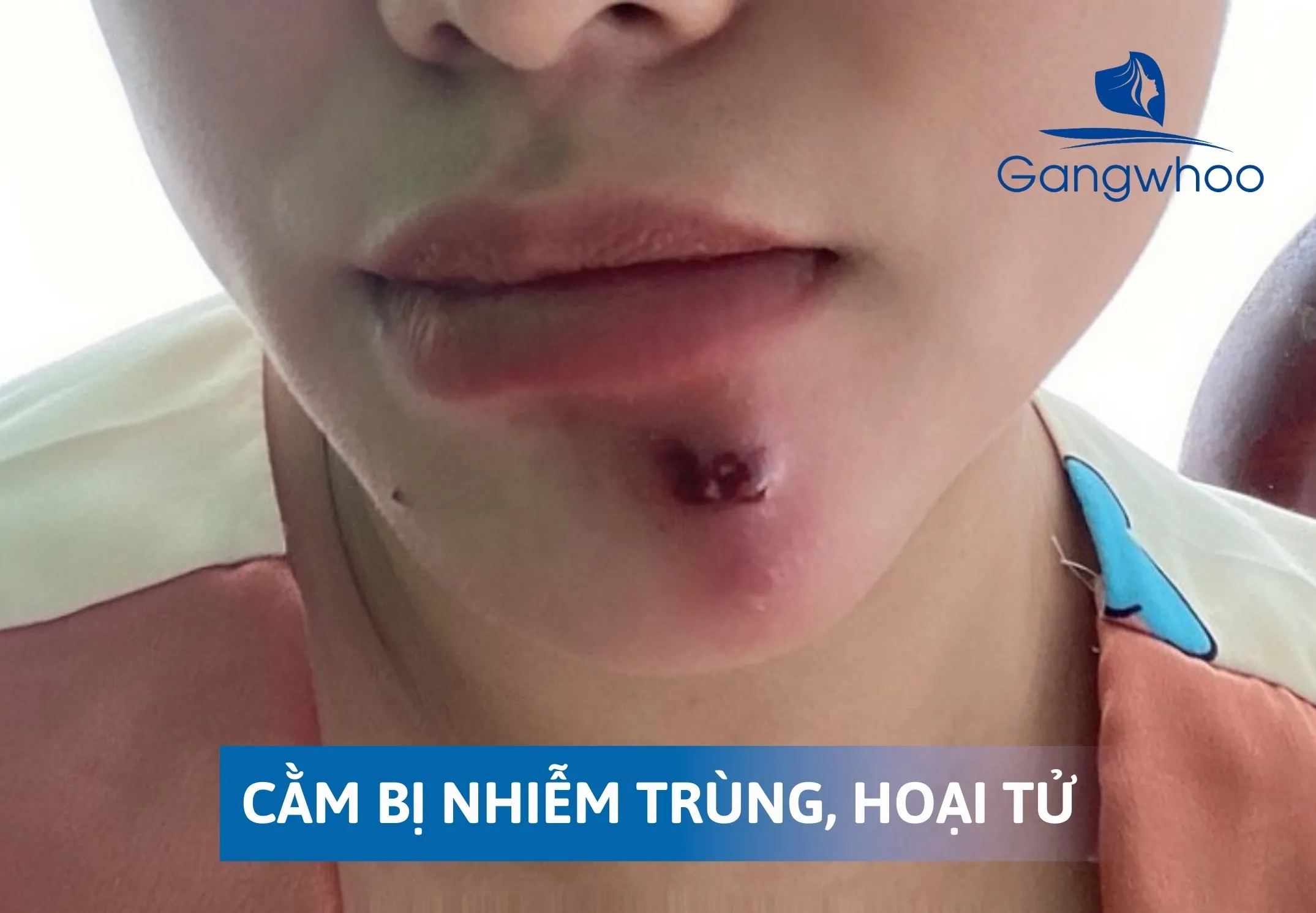 Những Tác Hại Của Trượt Cằm Mang Lại Sau Phẫu Thuật? 