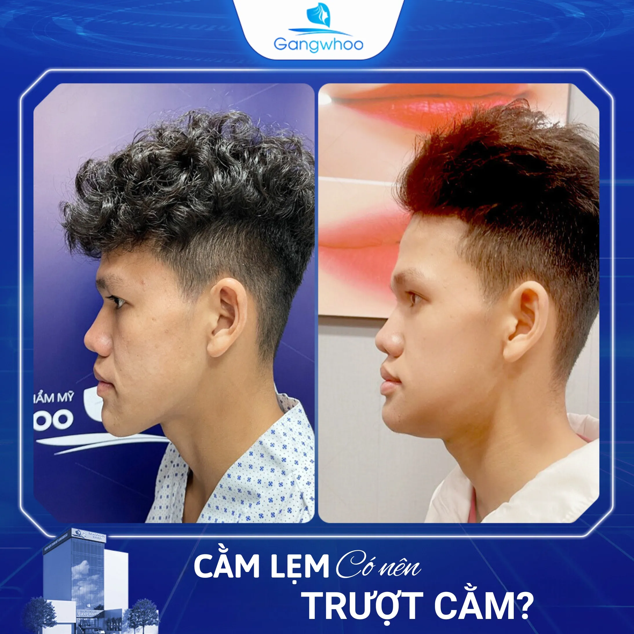 Cằm Lẹm Có Nên Trượt Cằm? Gợi Ý 2 Cách Khắc Phục Tại Nhà