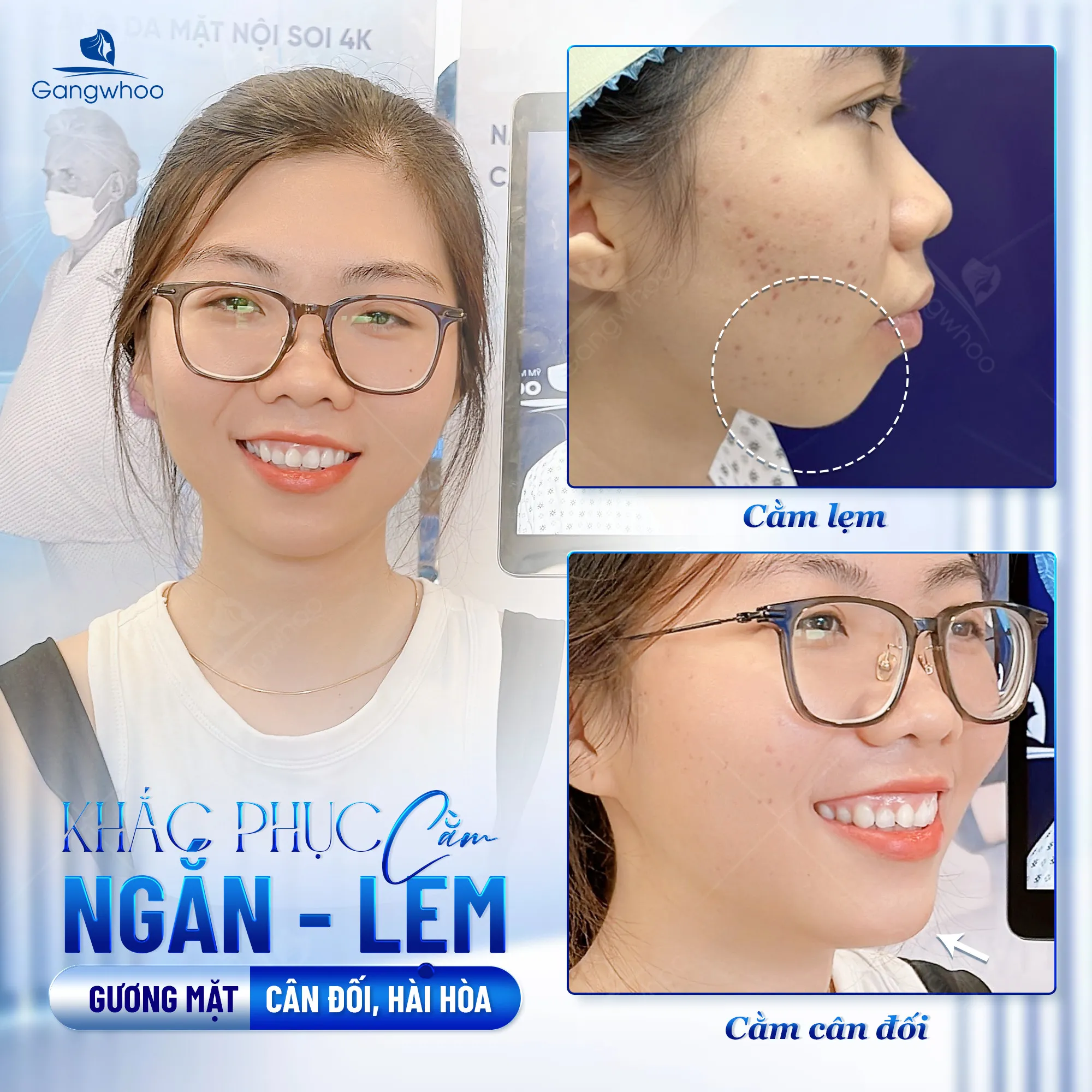 Cằm Lẹm Có Nên Trượt Cằm? Gợi Ý 2 Cách Khắc Phục Tại Nhà