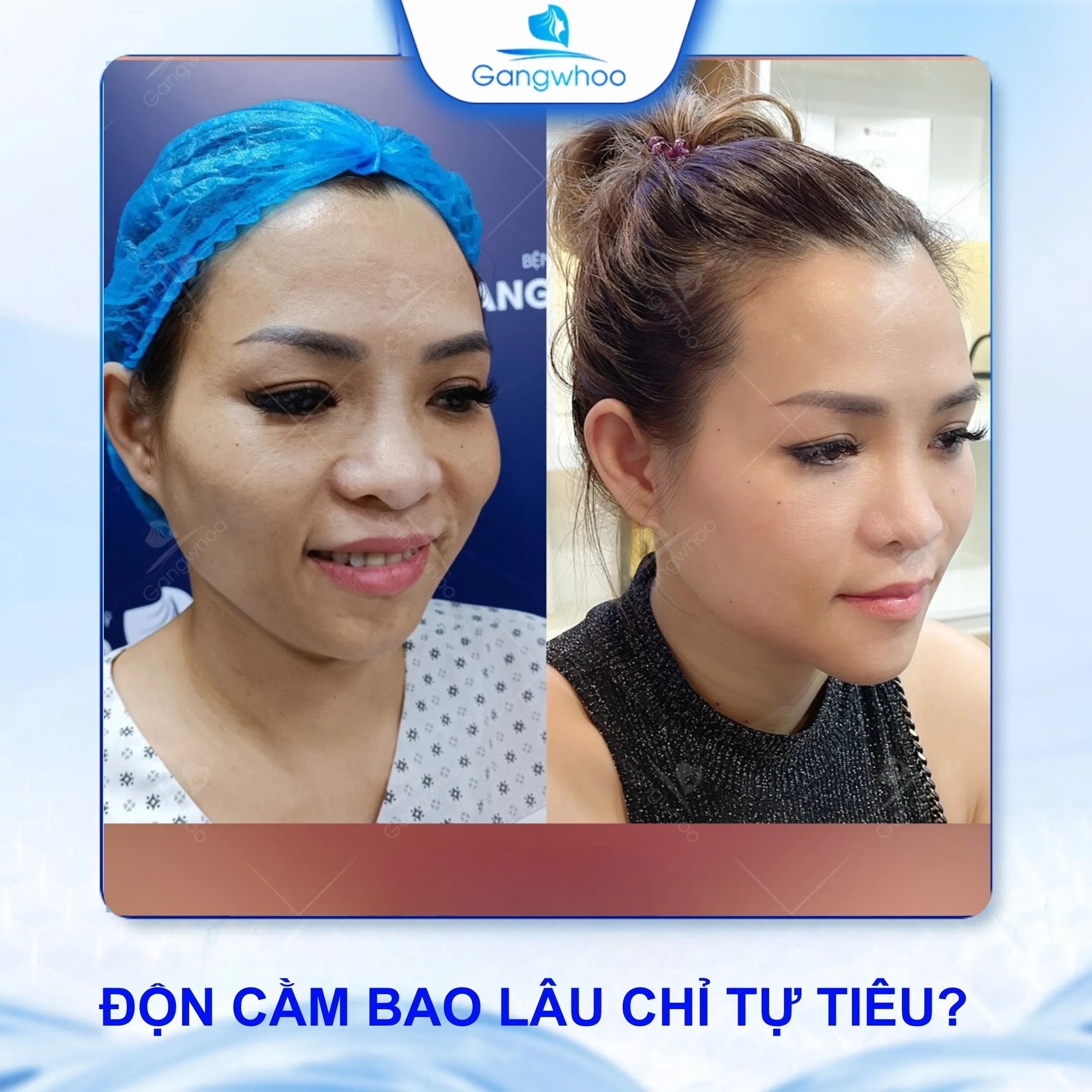 Độn Cằm Bao Lâu Thì Chỉ Tự Tiêu? Độn Cằm Bao Lâu Thì Đẹp?