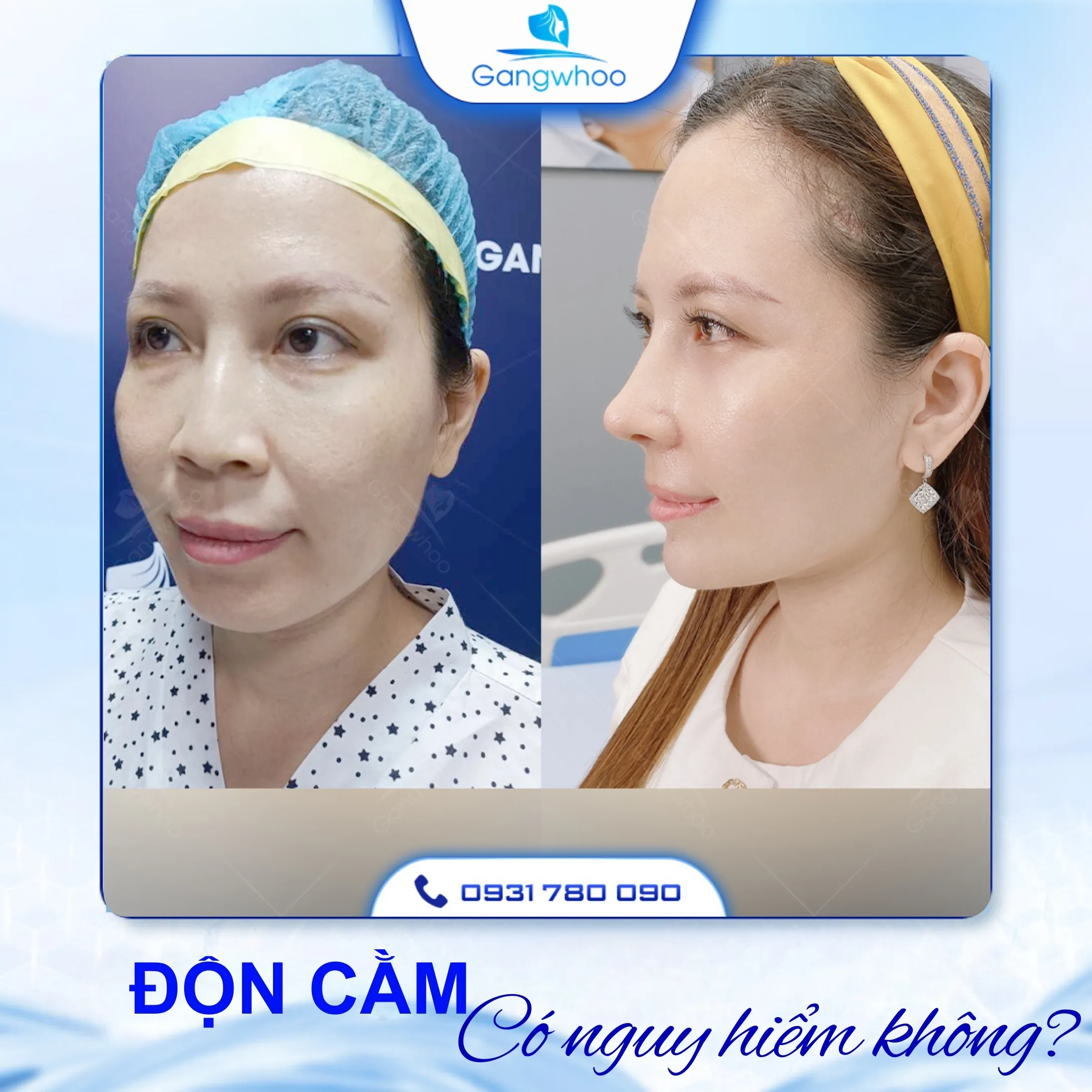 Độn Cằm Có Nguy Hiểm Không? 4 Yếu Tố Hạn Chế Nguy Hiểm