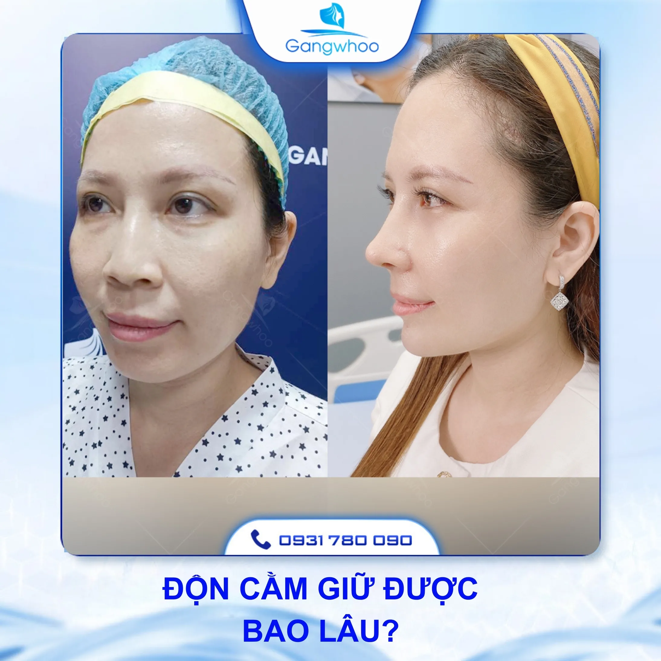 Độn Cằm Giữ Được Bao Lâu? 6 Lưu Ý Trước Khi Độn Cằm