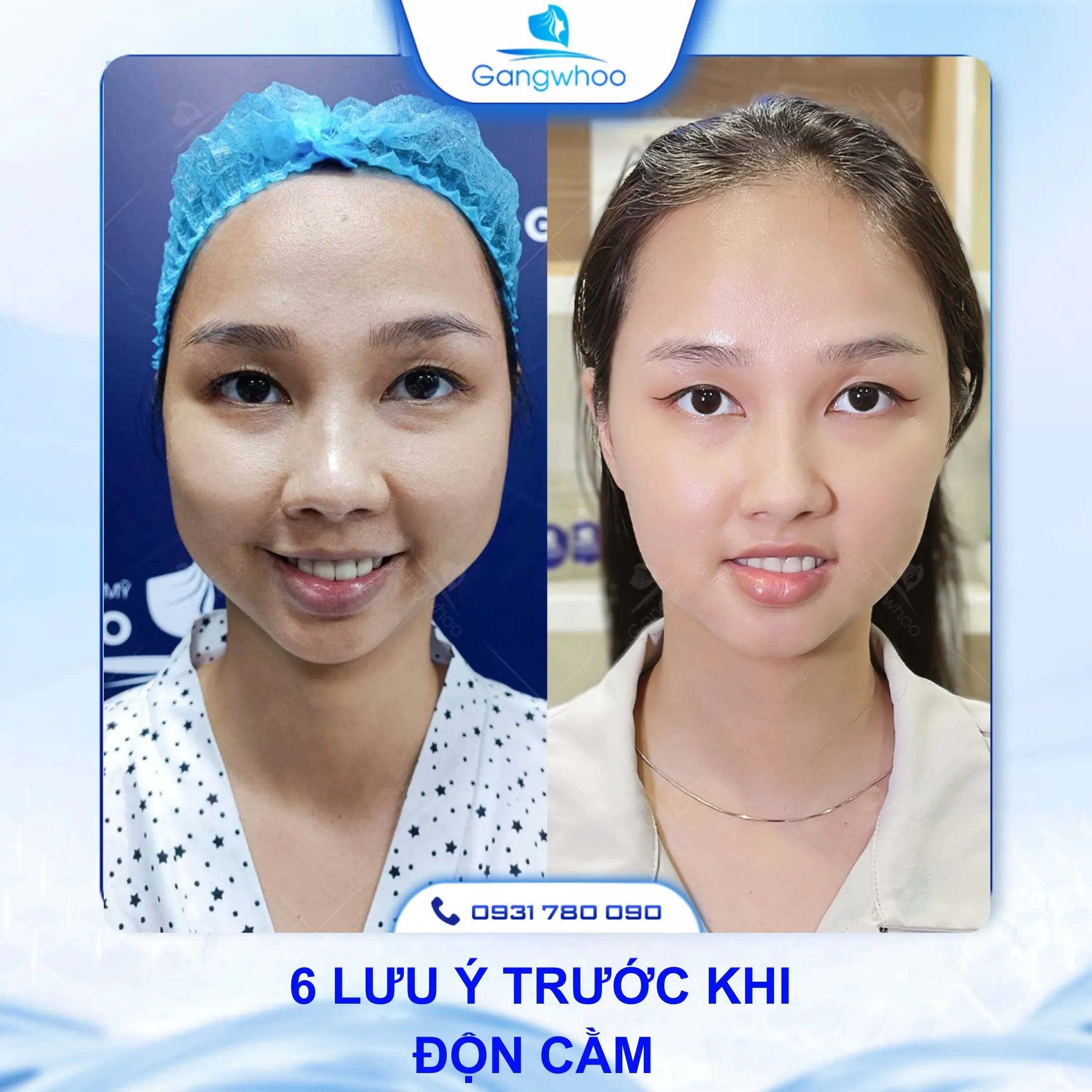 Độn Cằm Giữ Được Bao Lâu? 6 Lưu Ý Trước Khi Độn Cằm