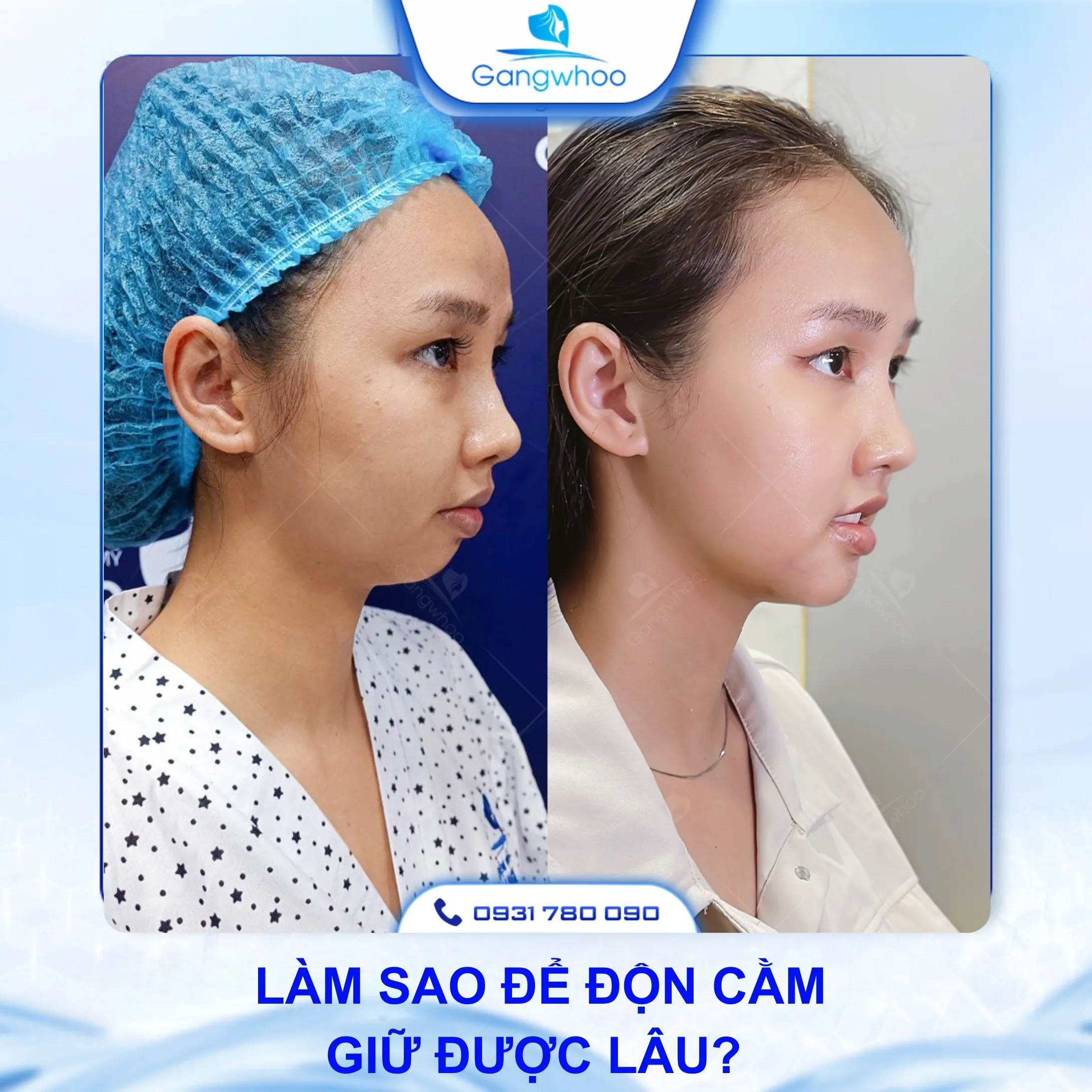 Độn Cằm Giữ Được Bao Lâu? 6 Lưu Ý Trước Khi Độn Cằm