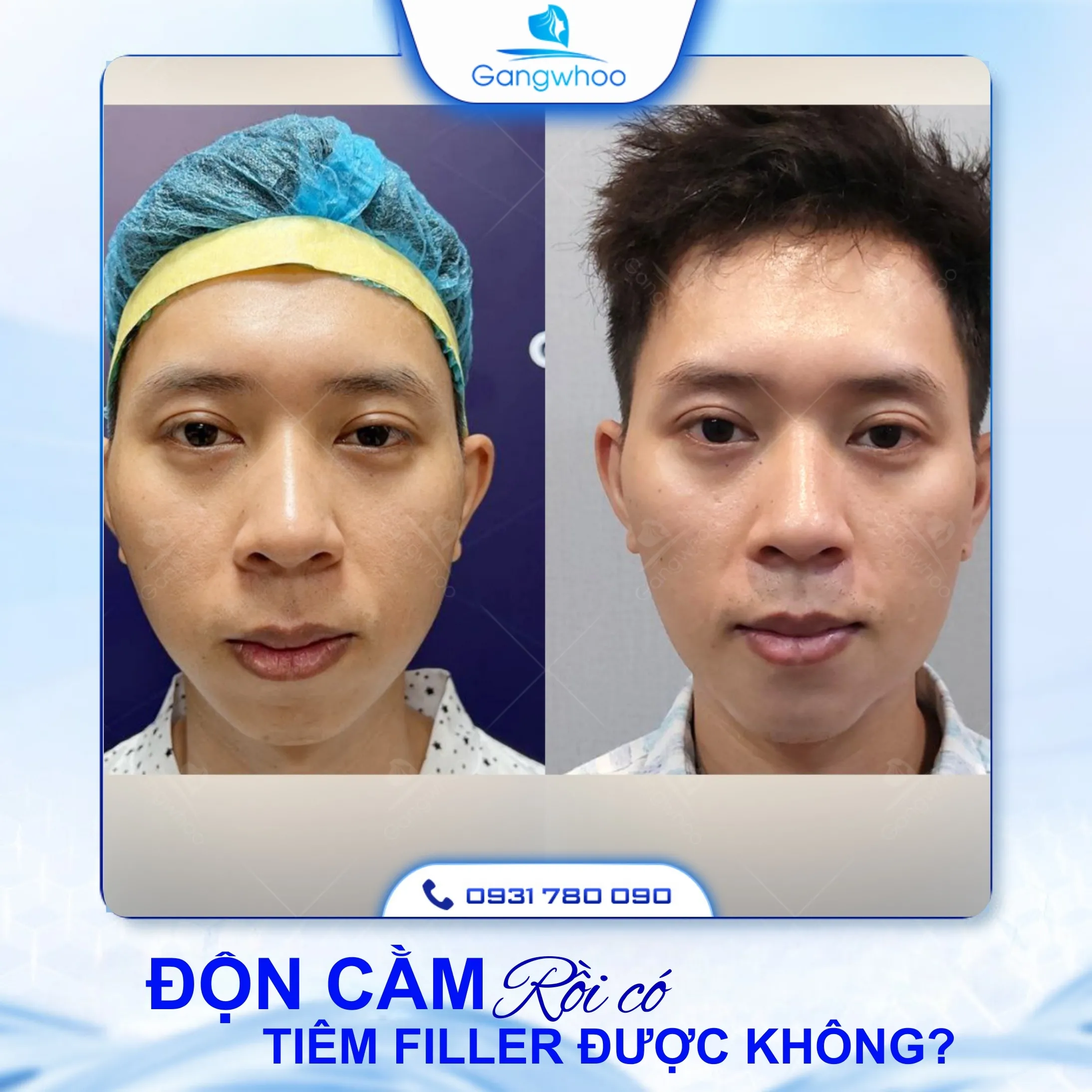 Hỏi Đáp: Độn Cằm Rồi Có Tiêm Filler Được Không?
