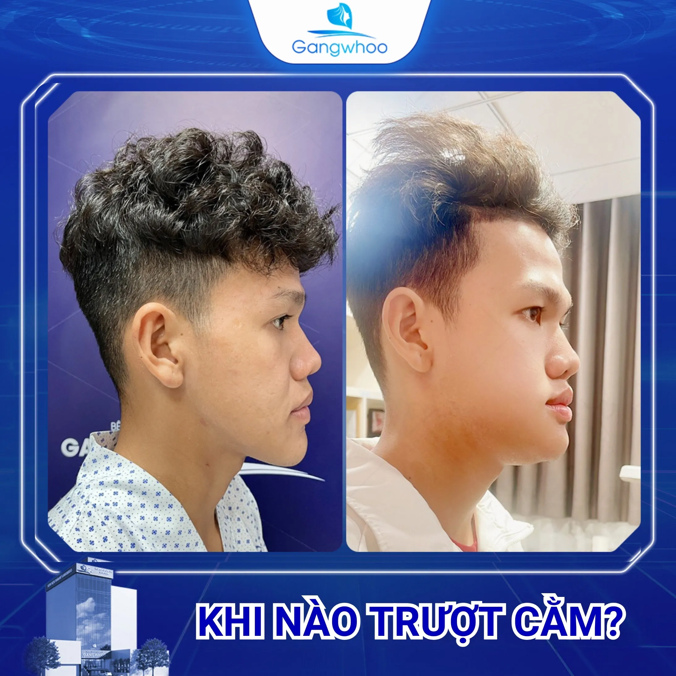Khi Nào Nên Trượt Cằm? Đối Tượng Nào Nên Trượt Cằm?