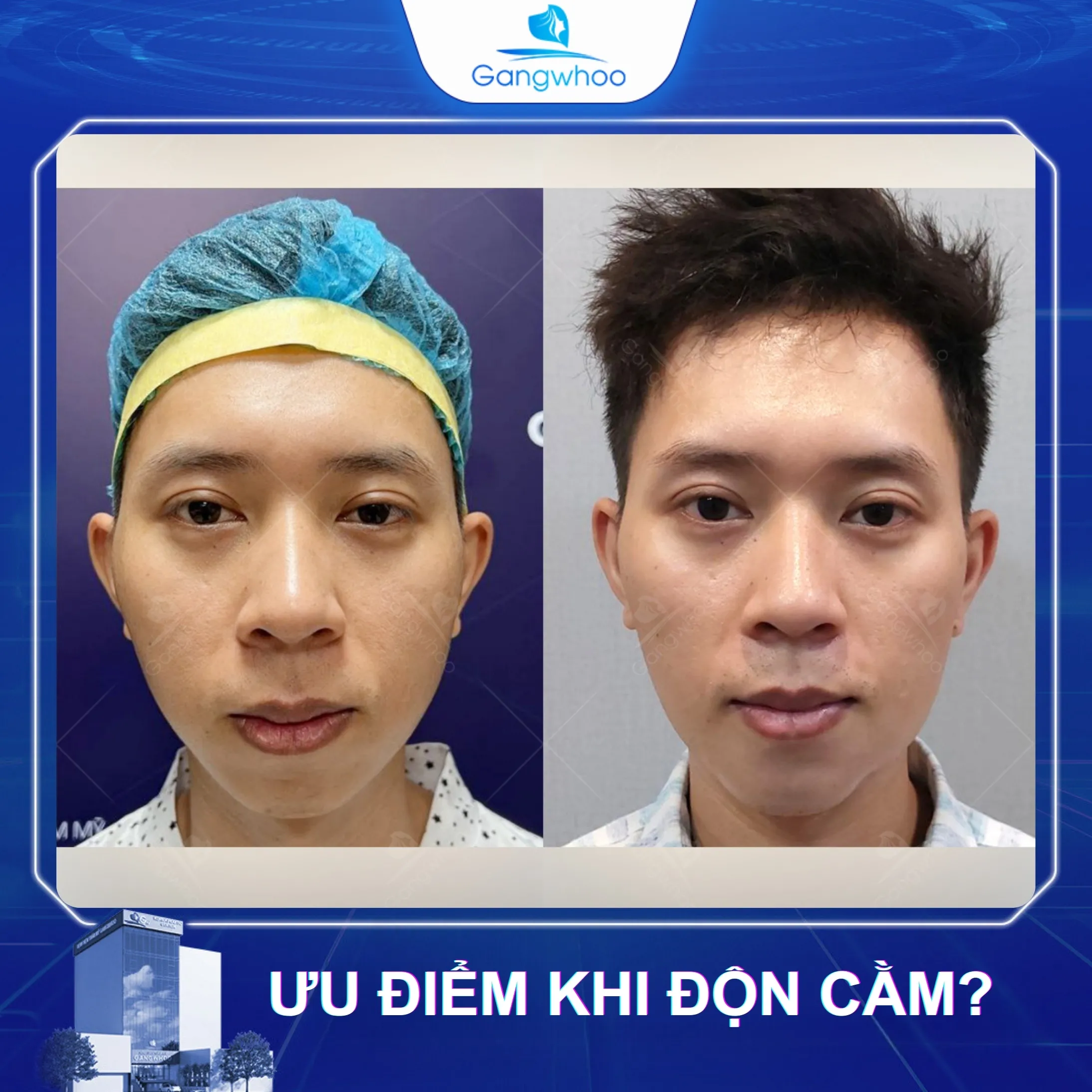 Nam Giới Có Độn Được Cằm Không? Ưu Điểm Của Độn Cằm