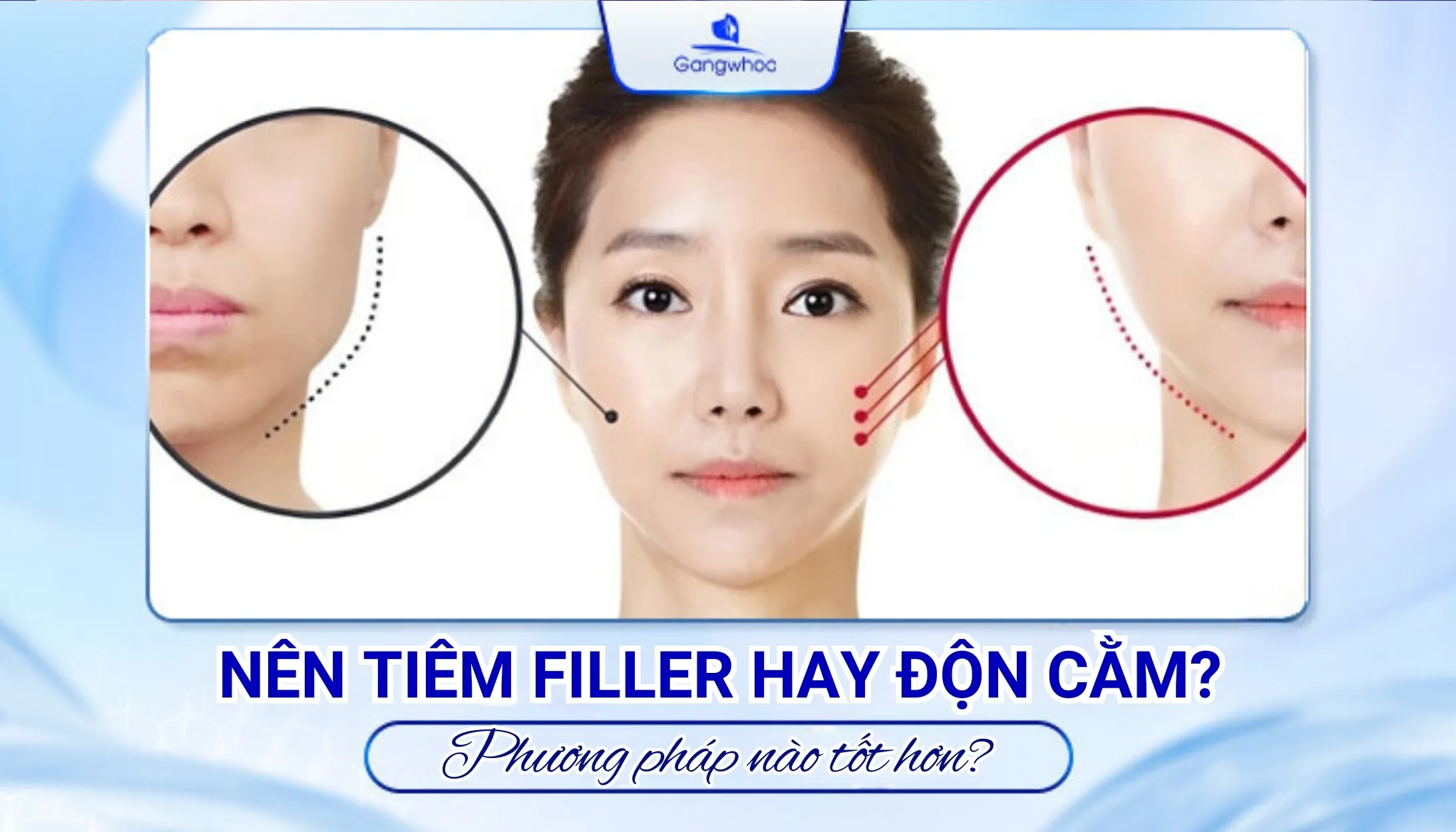Nên Tiêm Filler Hay Độn Cằm? Phương Pháp Nào Hiệu Qủa Hơn?