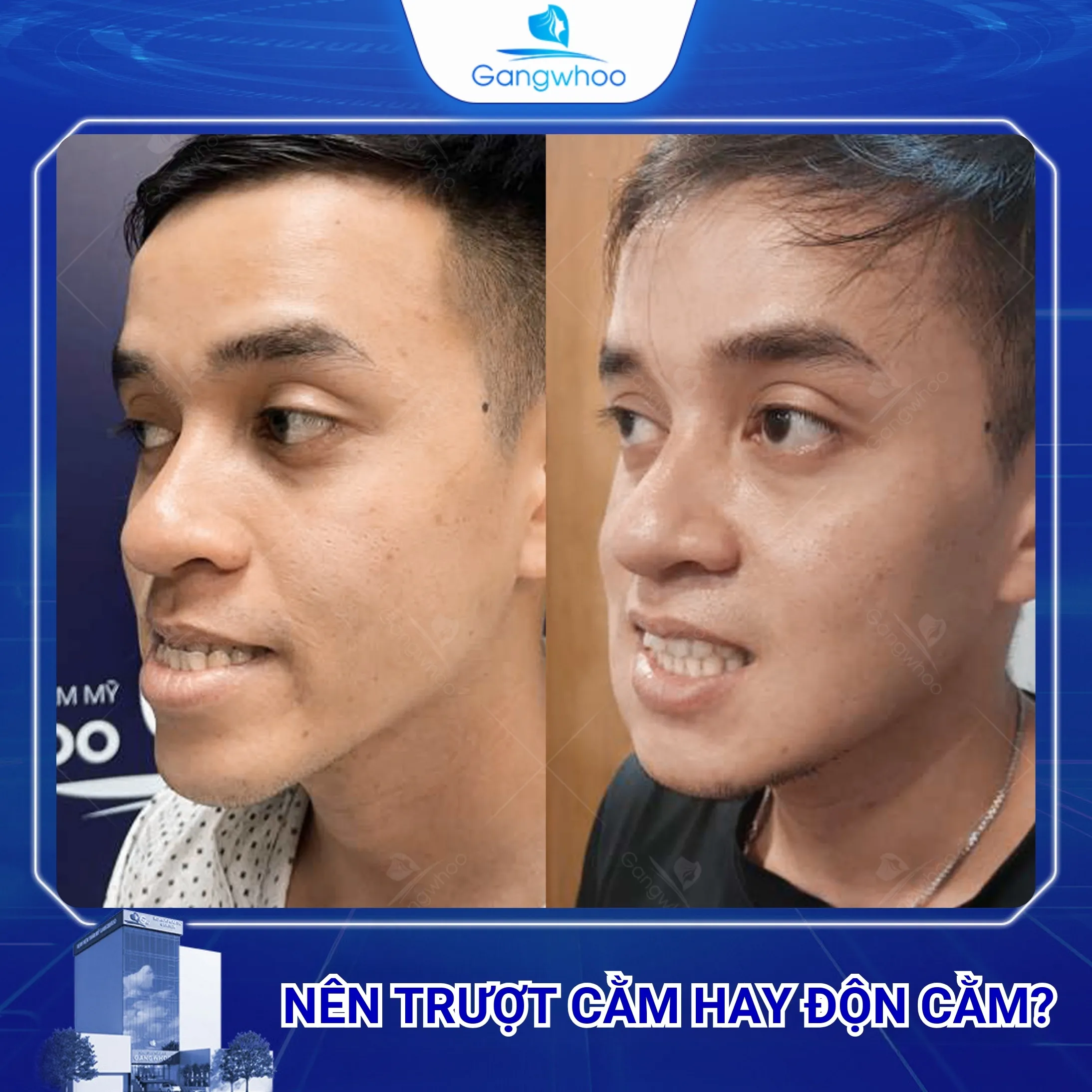 Nên Trượt Cằm Hay Độn Cằm? Phương Pháp Nào Tốt Hơn? 