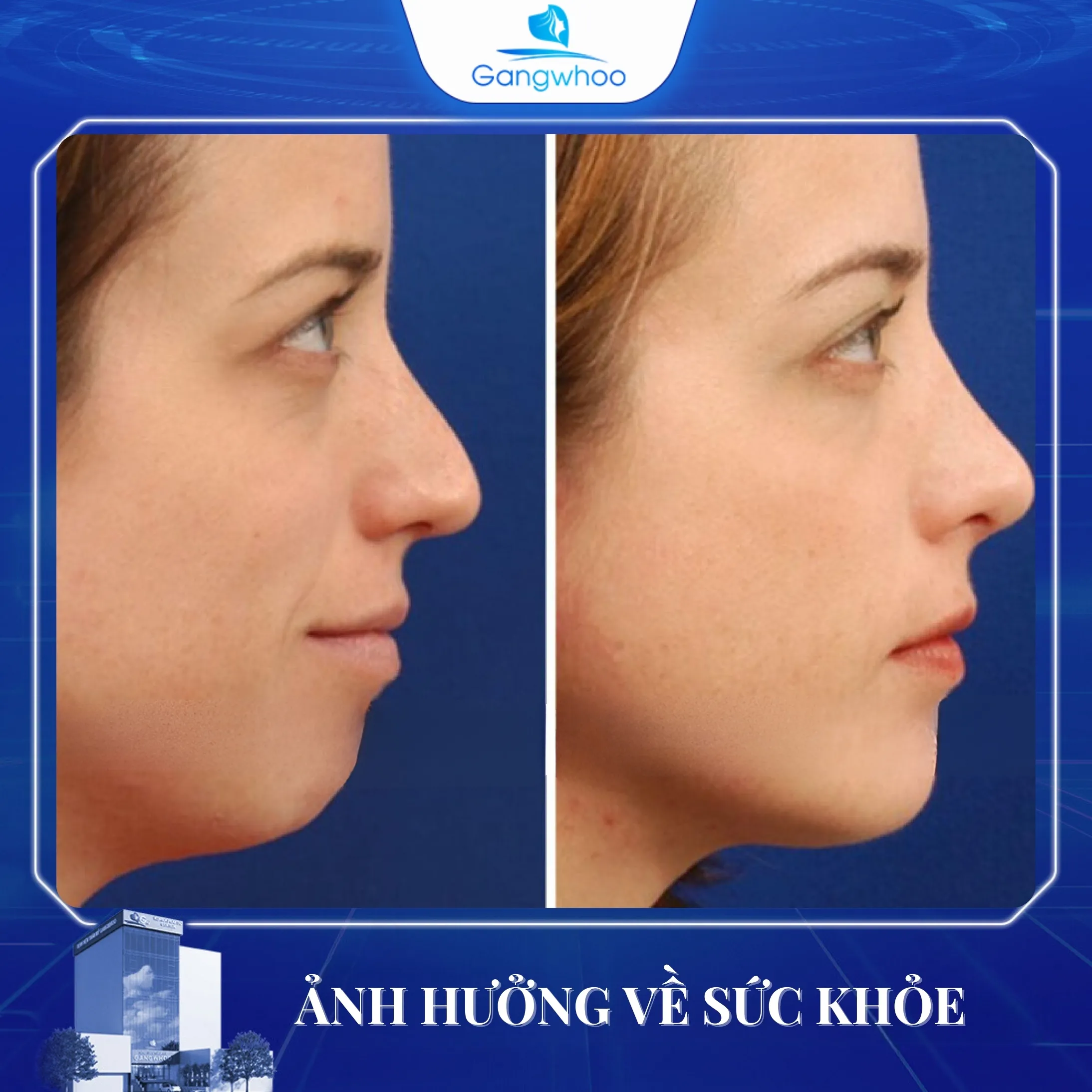 Trượt Cằm Có Ảnh Hưởng Về Lâu Dài Không?