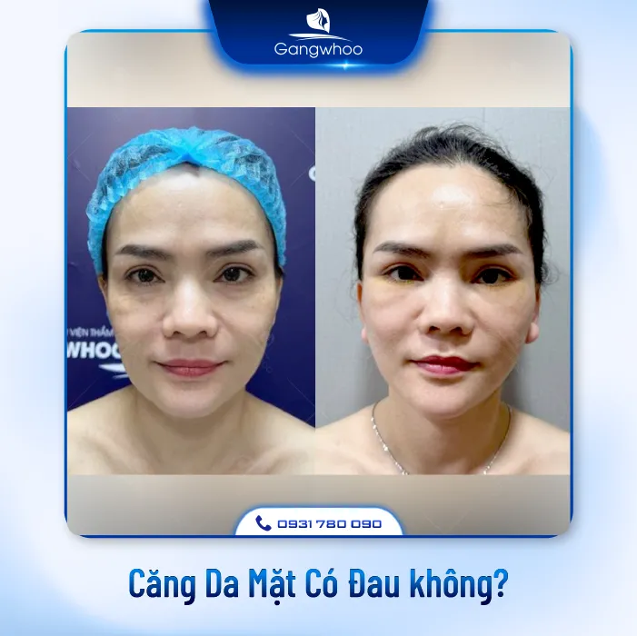 Căng Da Mặt Có Đau Không? 3 Cách Hạn Chế Đau Hiệu Quả