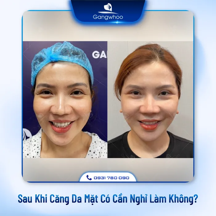 Giải Đáp: Sau Khi Căng Da Mặt Có Cần Nghỉ Làm Không?