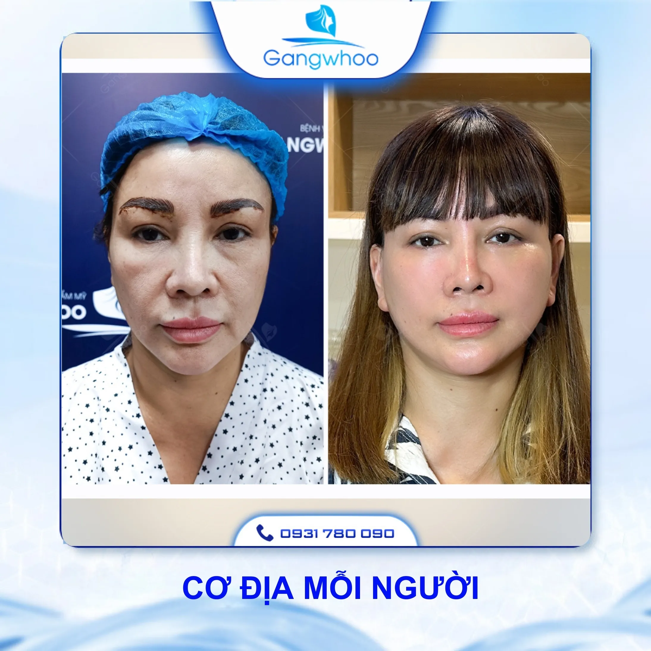 Căng Da Mặt Có Đau Không? 3 Cách Hạn Chế Đau Hiệu Quả