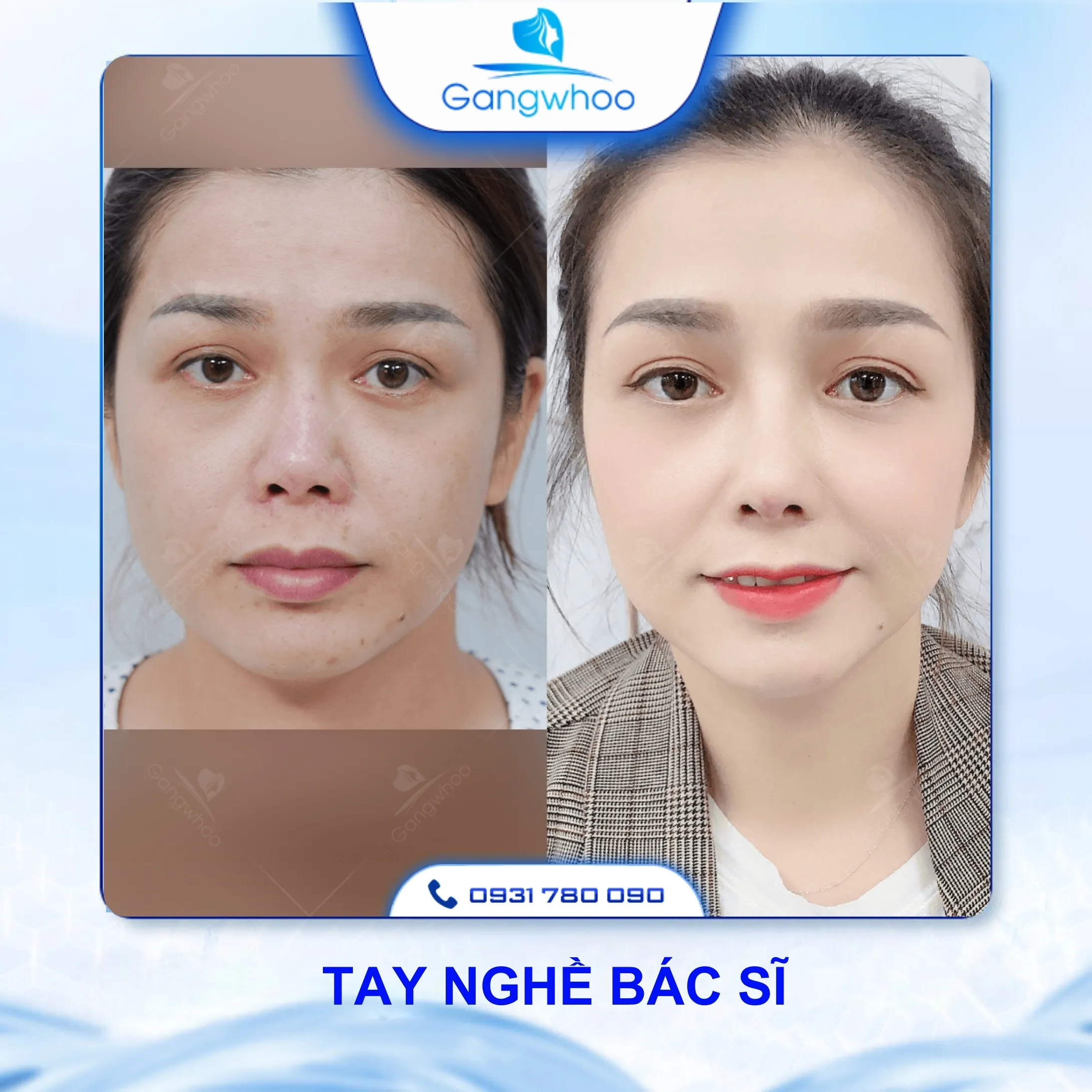 Căng Da Mặt Có Đau Không? 3 Cách Hạn Chế Đau Hiệu Quả