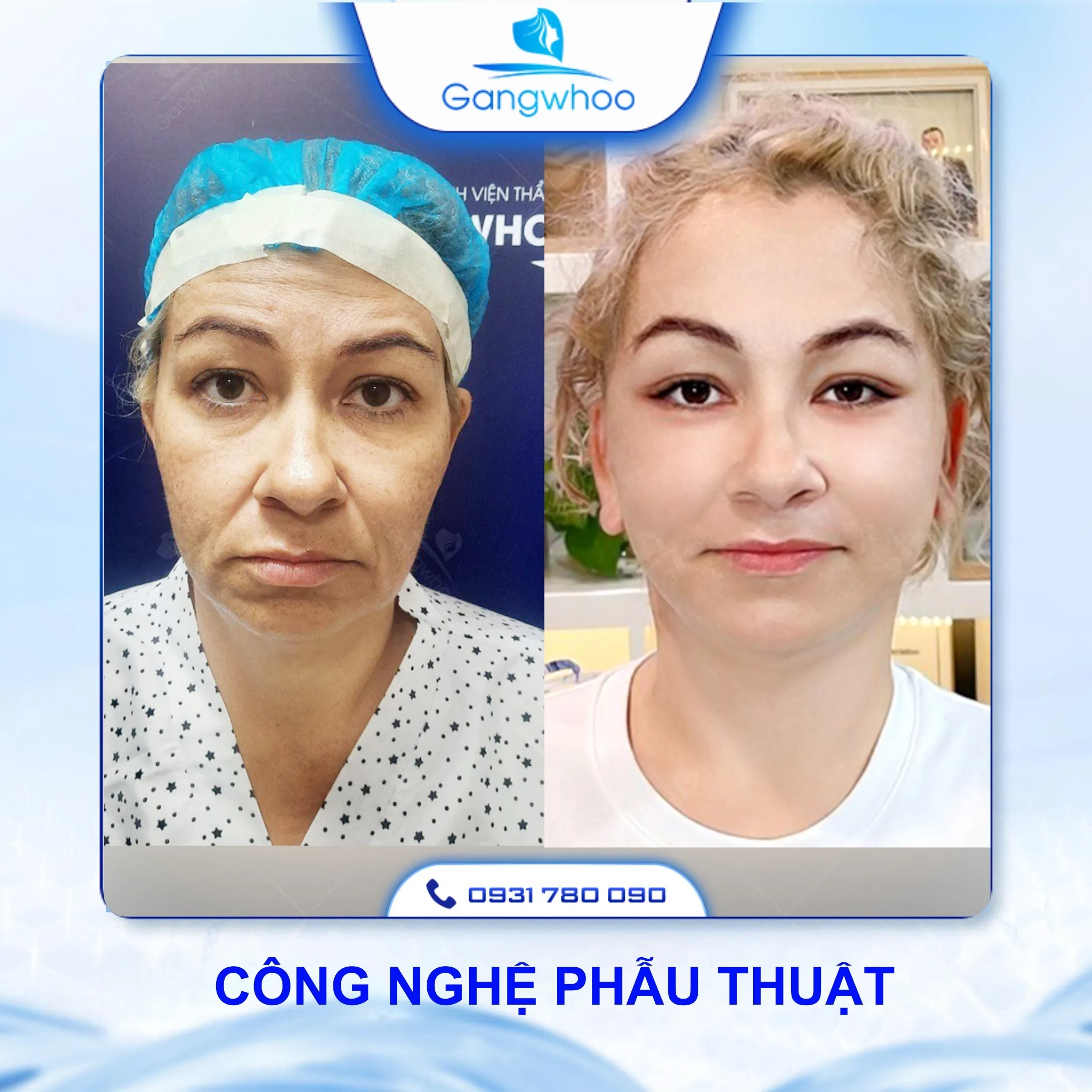 Căng Da Mặt Có Đau Không? 3 Cách Hạn Chế Đau Hiệu Quả