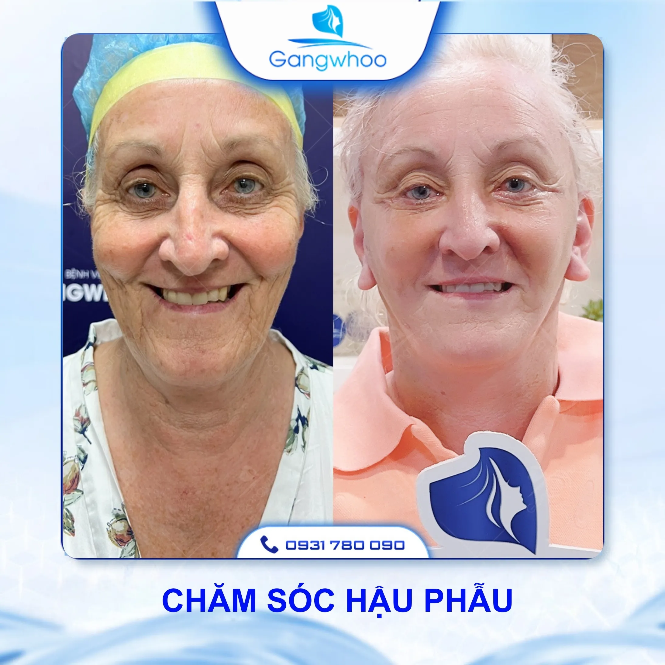 Căng Da Mặt Có Đau Không? 3 Cách Hạn Chế Đau Hiệu Quả