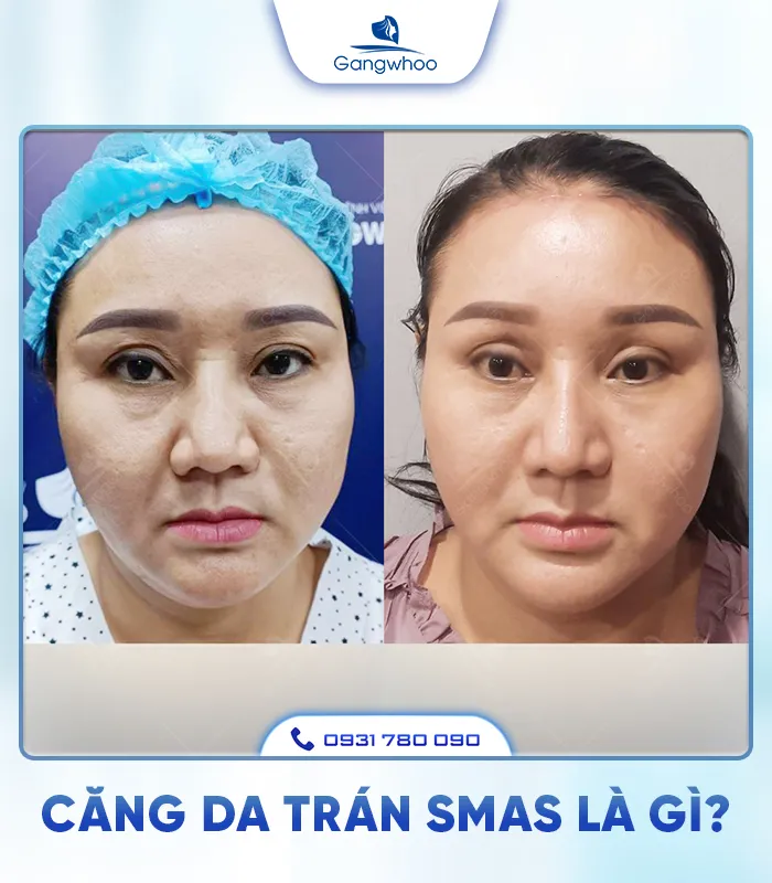 Căng Da Trán SMAS – Trẻ Hóa Làn Da Lấy Lại Thanh Xuân  