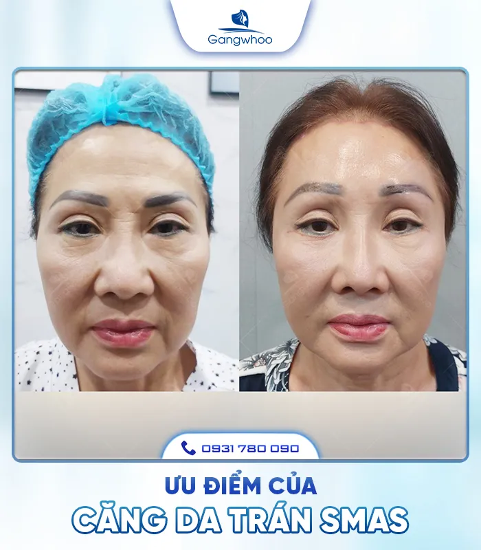 Căng Da Trán SMAS – Trẻ Hóa Làn Da Lấy Lại Thanh Xuân  