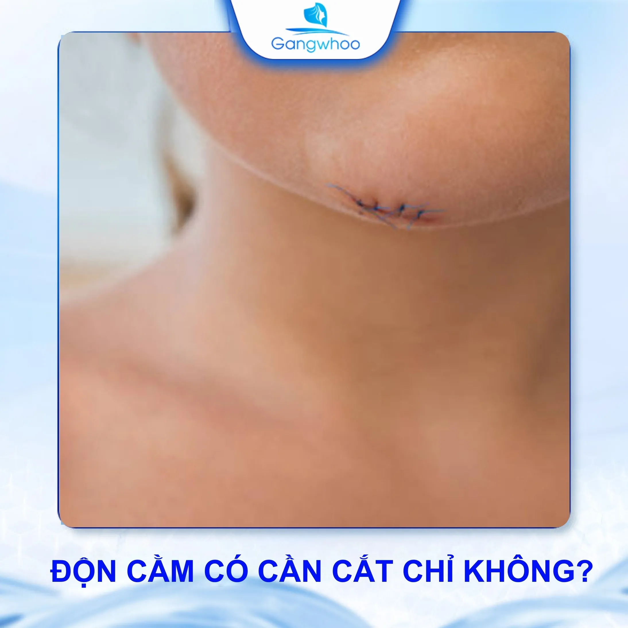 Độn Cằm Có Cần Cắt Chỉ Không? Bao lâu Thì Cắt Chỉ