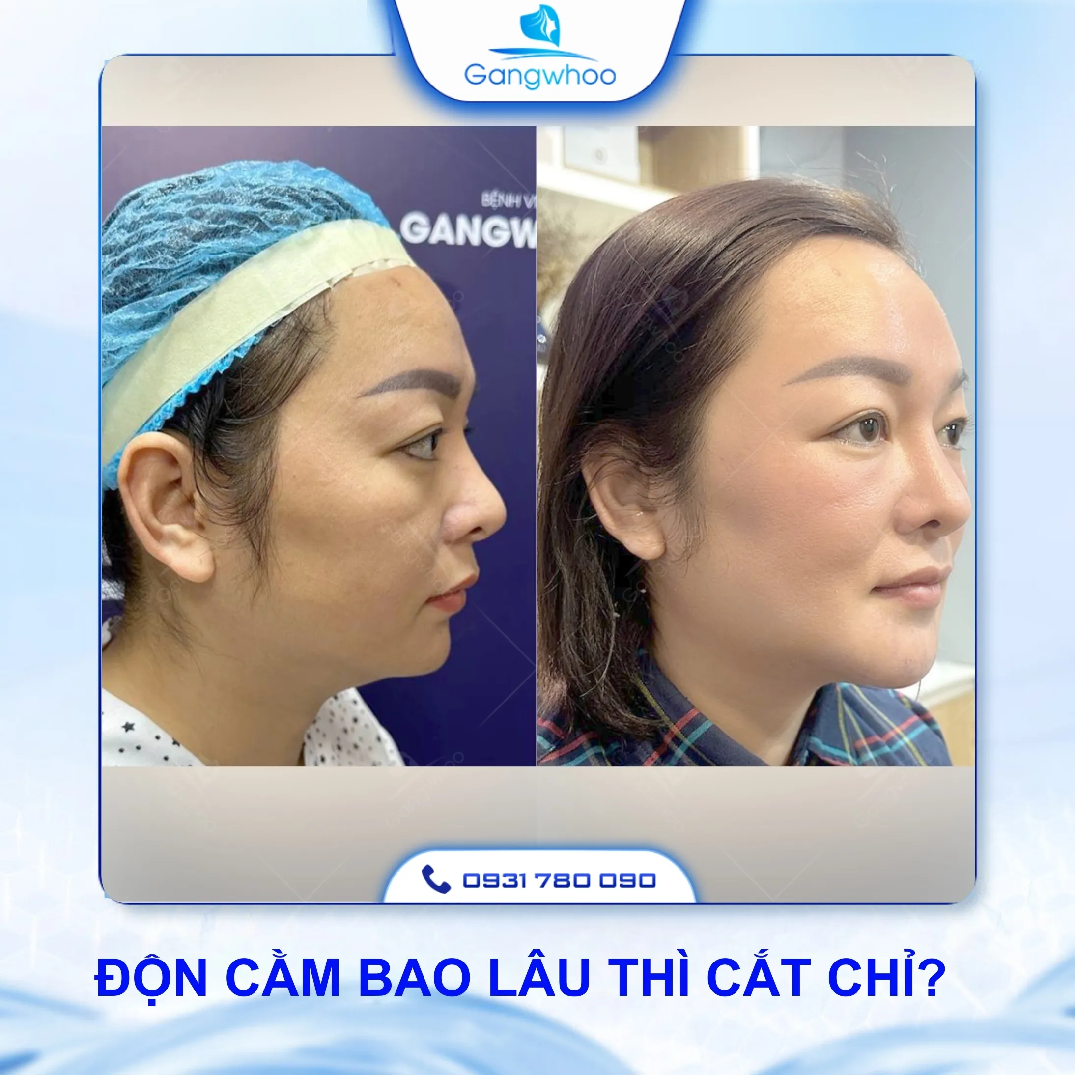Độn Cằm Có Cần Cắt Chỉ Không? Bao lâu Thì Cắt Chỉ