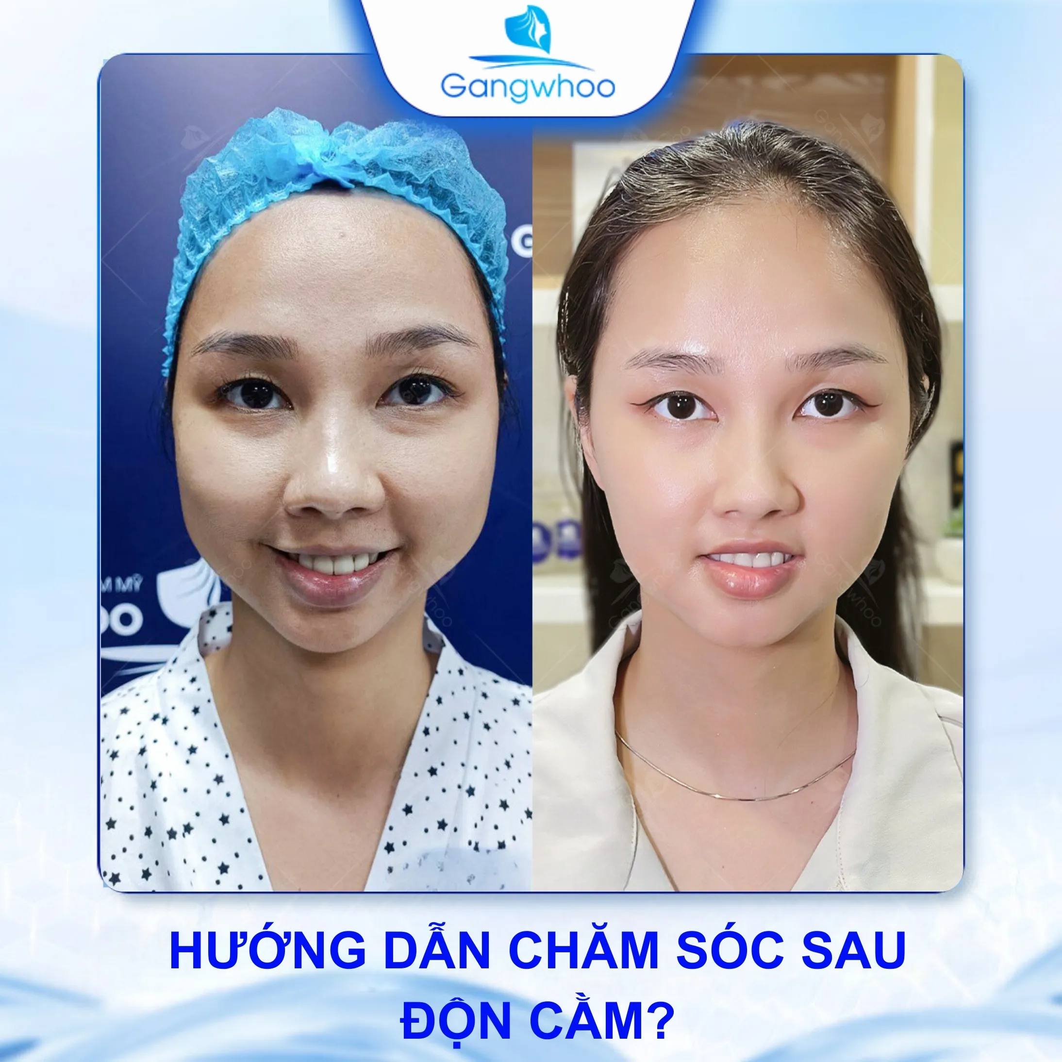 Độn Cằm Có Cần Cắt Chỉ Không? Bao lâu Thì Cắt Chỉ