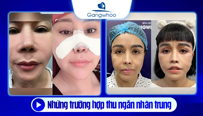 Nhân Trung Dài Phải Làm Sao? Giải Pháp Thu Ngắn Nhân Trung Hiệu Quả