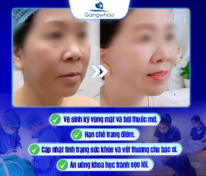 Nhân Trung Dài Phải Làm Sao? Giải Pháp Thu Ngắn Nhân Trung Hiệu Quả